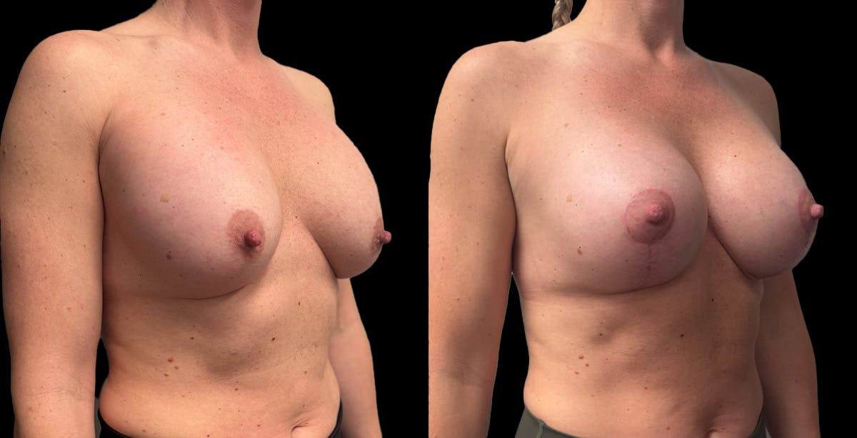 Breast Implant Exchange Before & After Gallery - Patient 128593 - Image 2