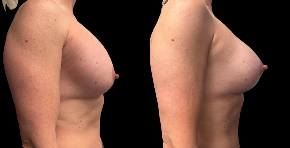 Breast Implant Exchange Before & After Gallery - Patient 128593 - Image 3