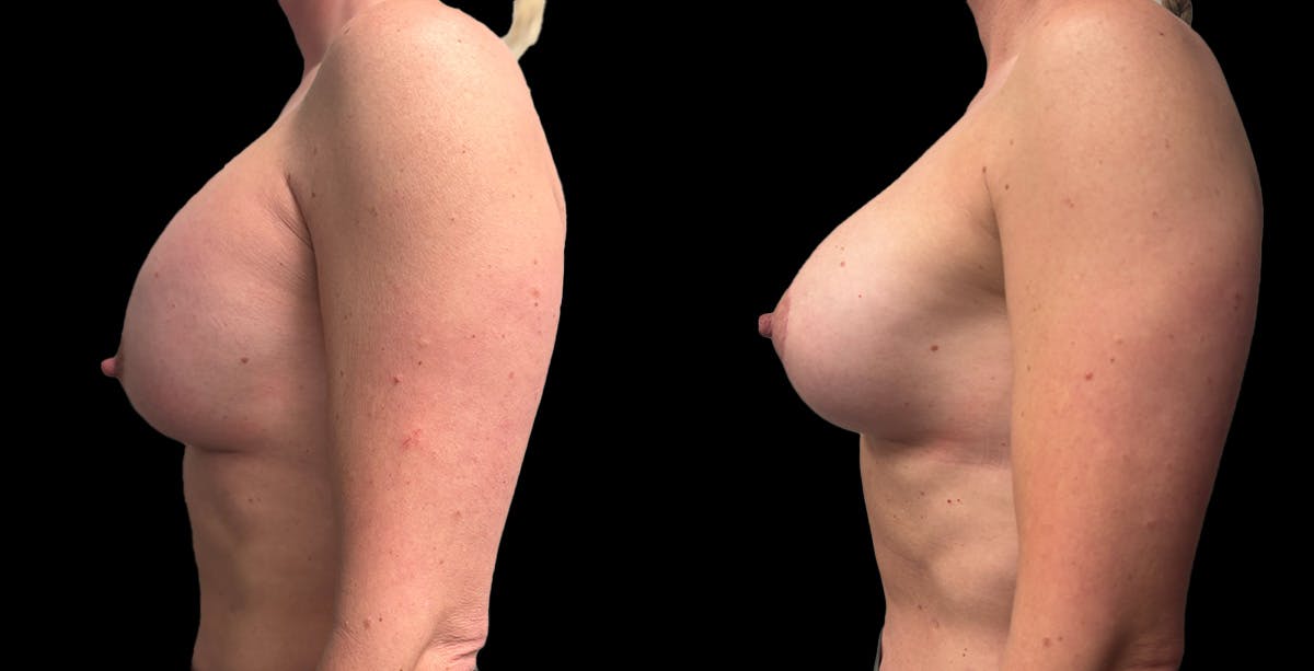 Breast Implant Exchange Before & After Gallery - Patient 128593 - Image 5