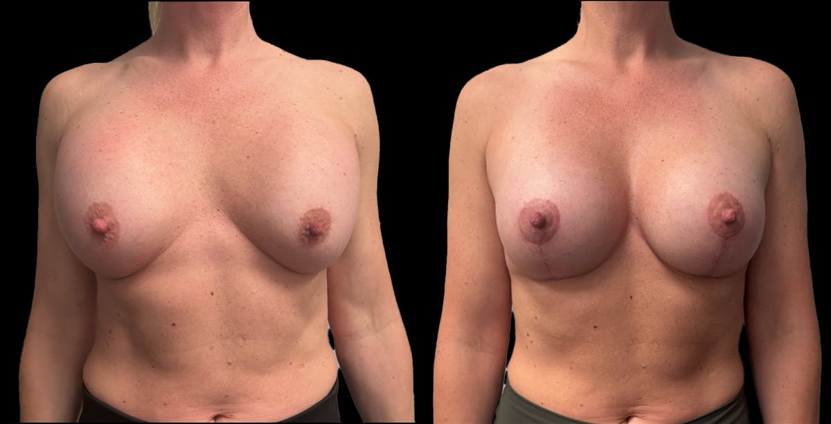 Breast Implant Exchange Before & After Gallery - Patient 128593 - Image 1