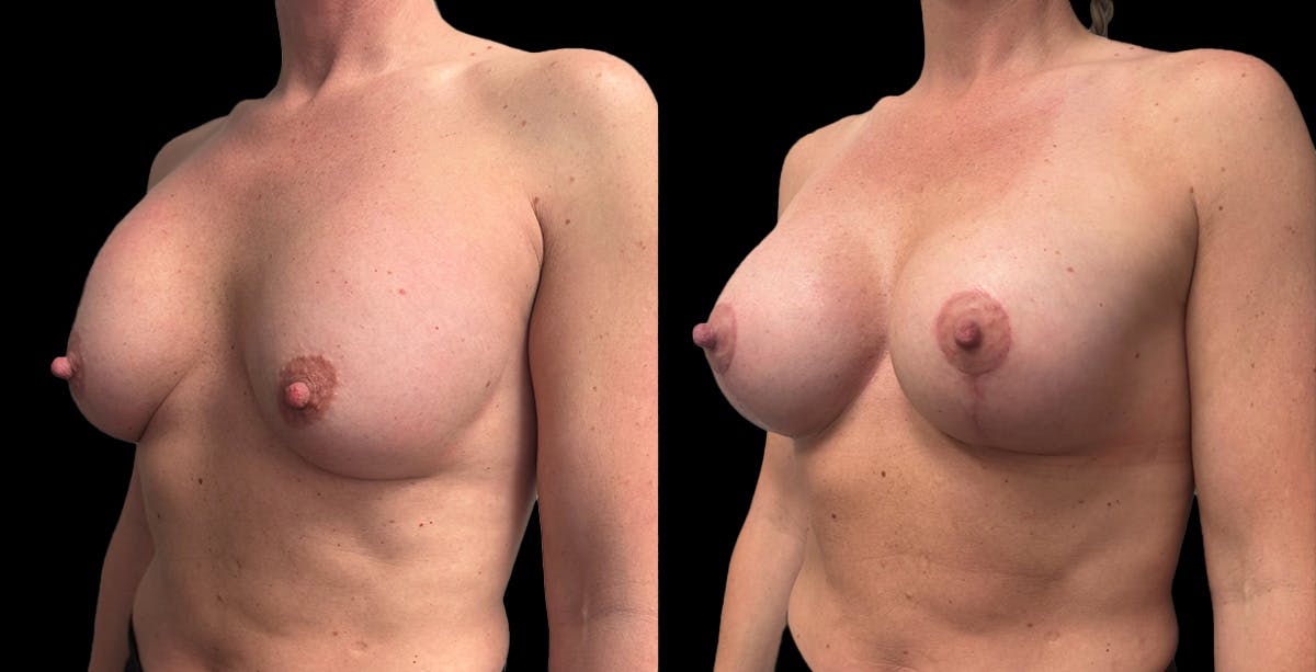 Breast Implant Exchange Before & After Gallery - Patient 128593 - Image 4