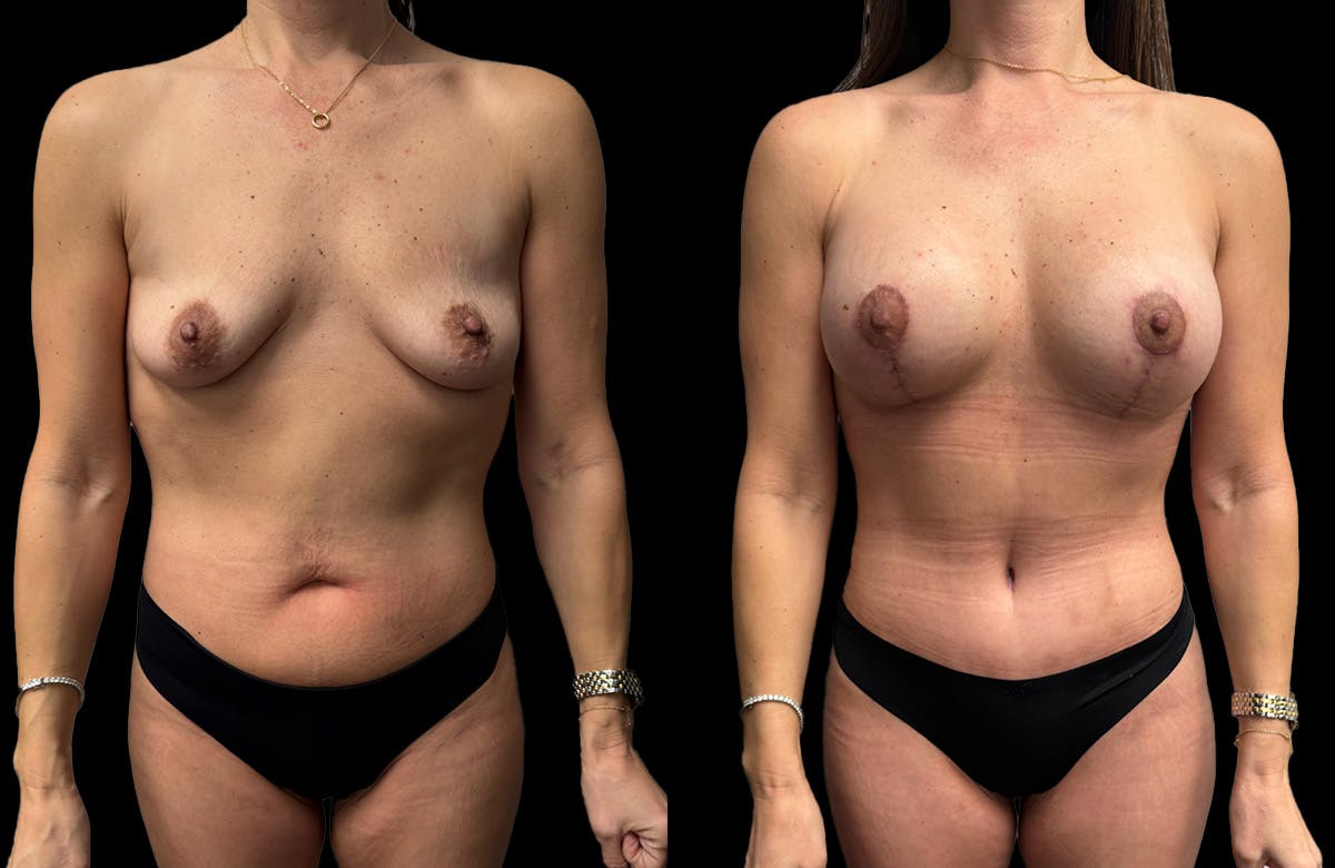 Mommy Makeover Before & After Gallery - Patient 161794 - Image 3