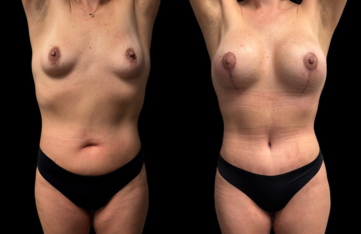 Mommy Makeover Before & After Gallery - Patient 161794 - Image 4