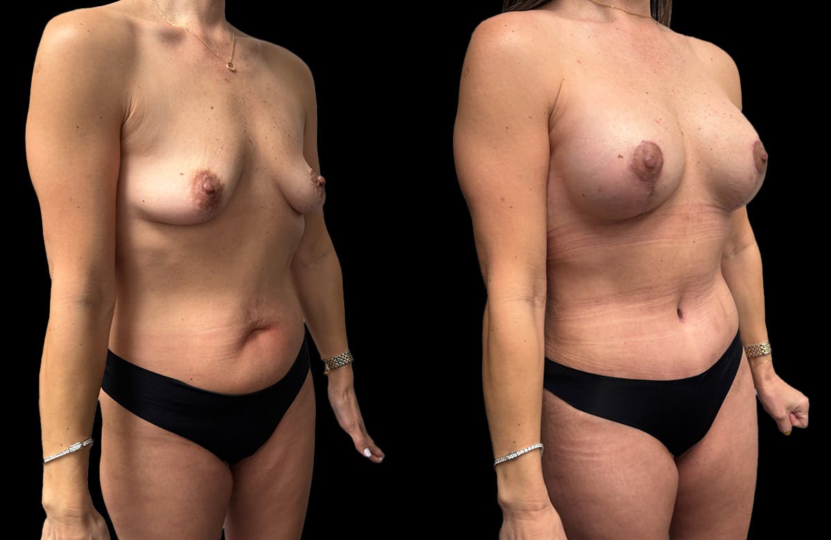 Mommy Makeover Before & After Gallery - Patient 161794 - Image 5