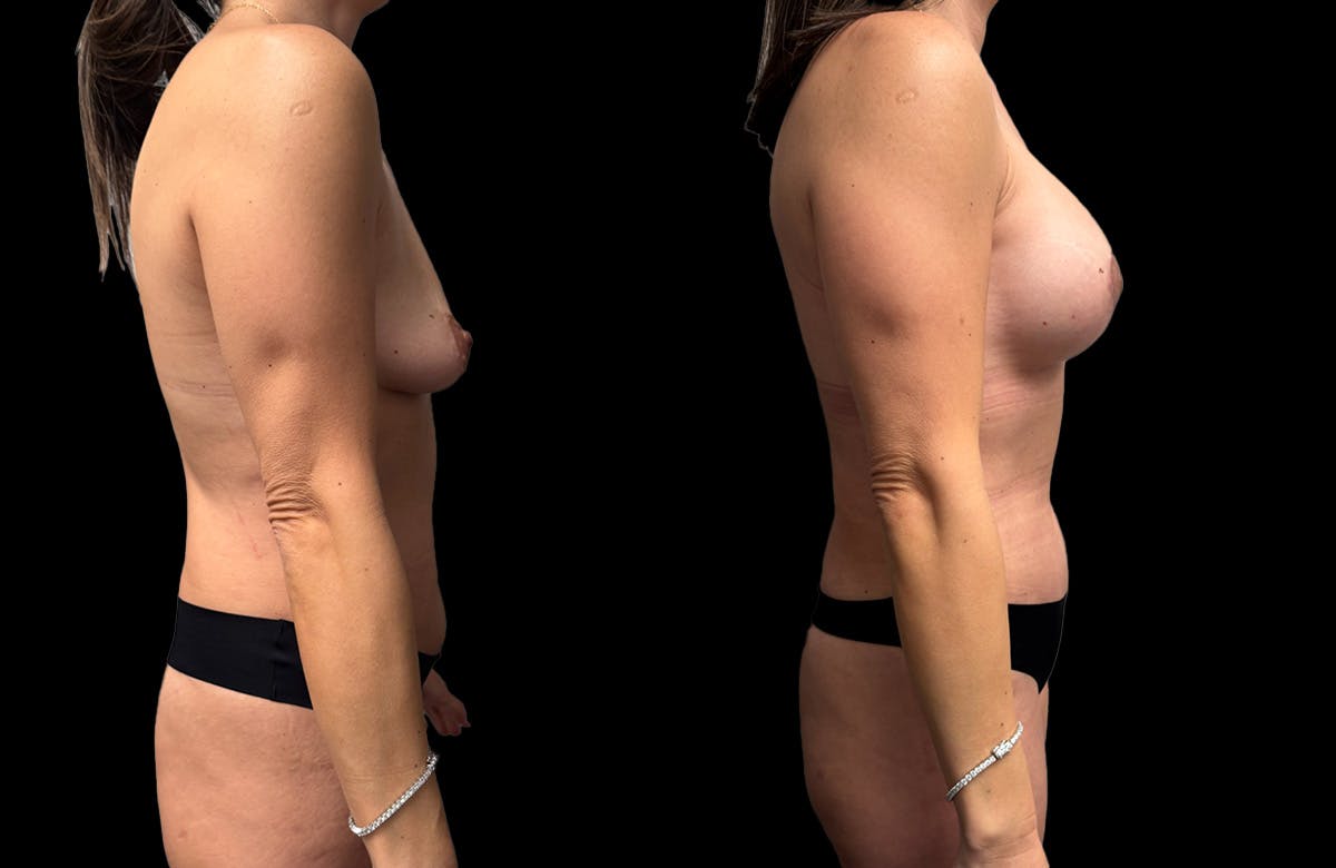 Mommy Makeover Before & After Gallery - Patient 161794 - Image 7