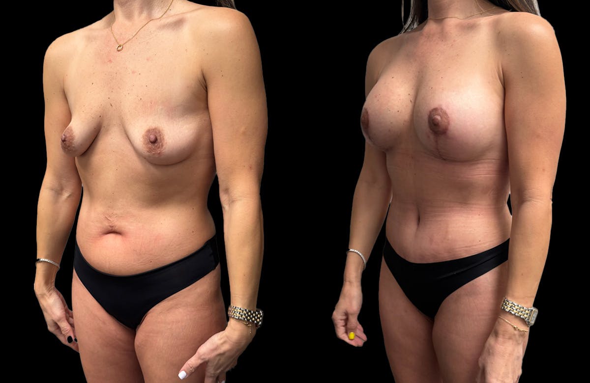 Mommy Makeover Before & After Gallery - Patient 161794 - Image 1