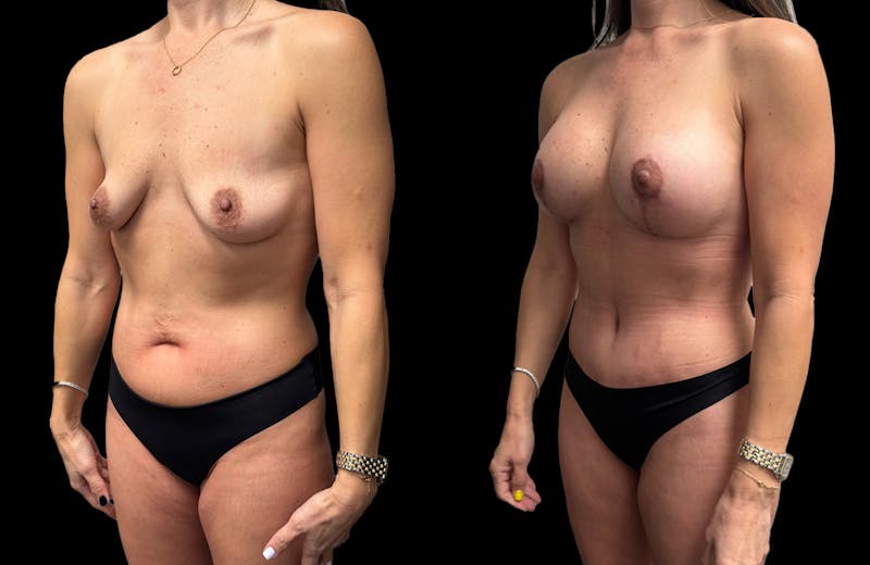 Mommy Makeover Before & After Gallery - Patient 161794 - Image 1