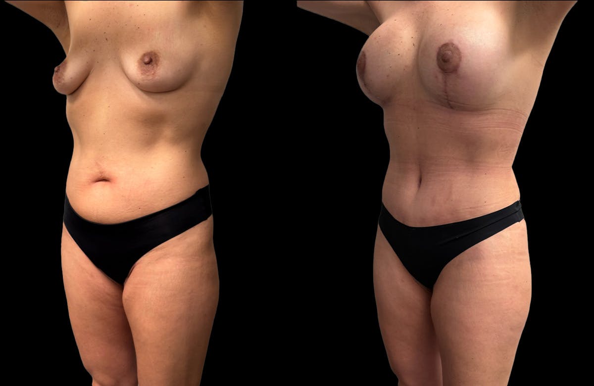 Mommy Makeover Before & After Gallery - Patient 161794 - Image 2