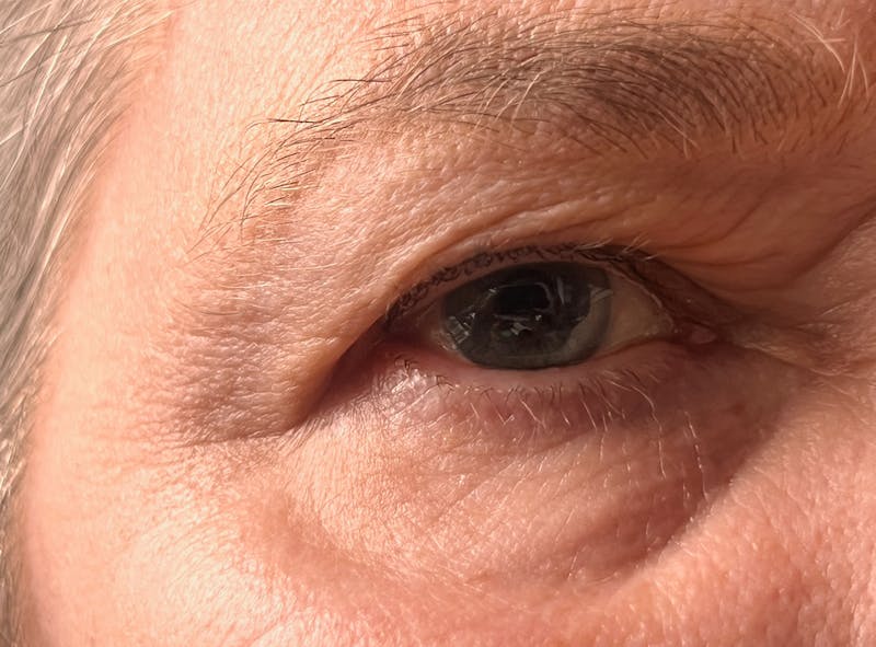 Hooded eyelid
