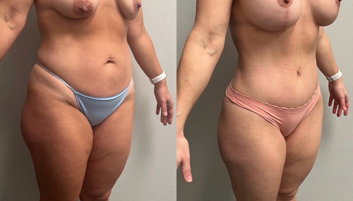 Tummy Tuck Before & After Gallery - Patient 201634 - Image 2