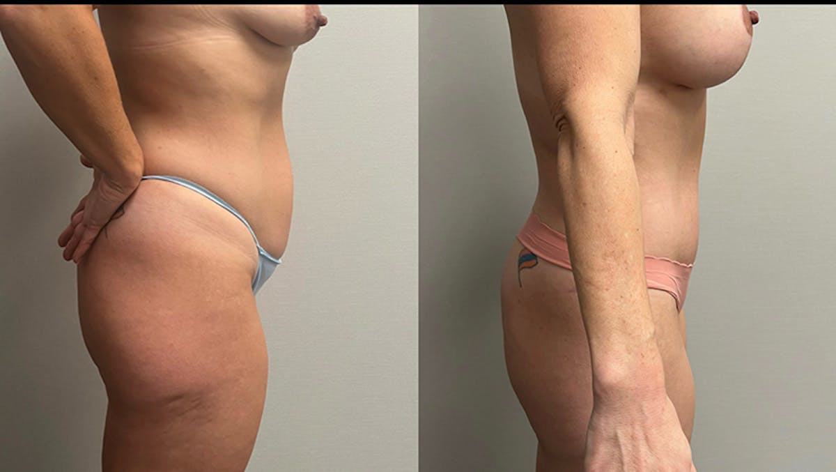 Tummy Tuck Before & After Gallery - Patient 201634 - Image 3