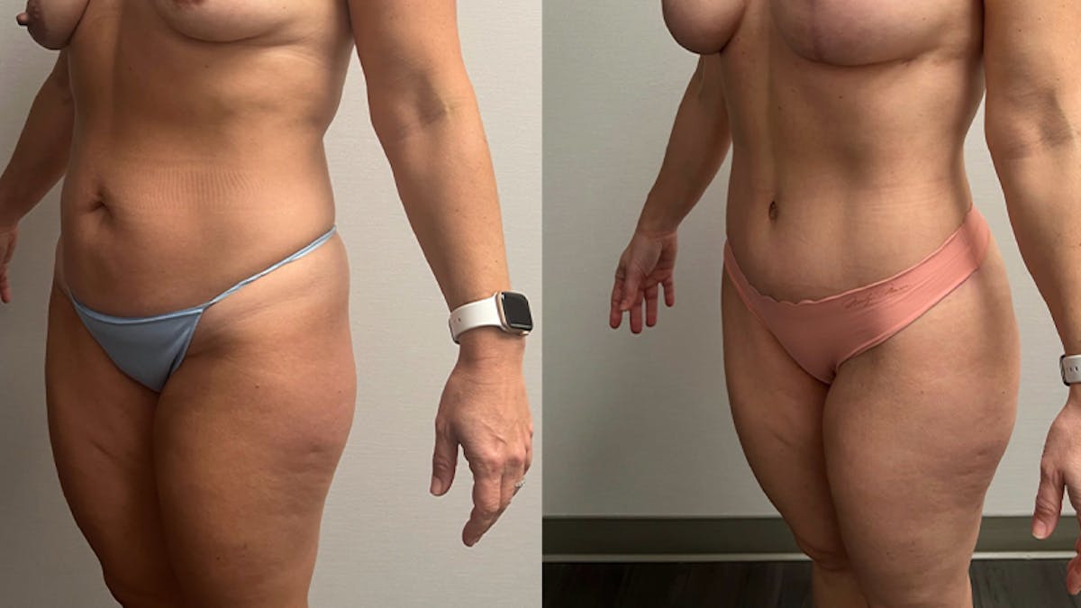 Tummy Tuck Before & After Gallery - Patient 201634 - Image 4