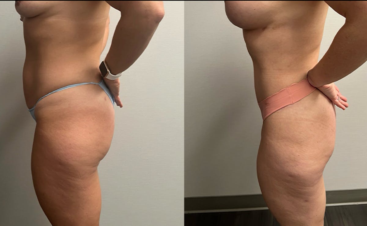 Tummy Tuck Before & After Gallery - Patient 201634 - Image 5