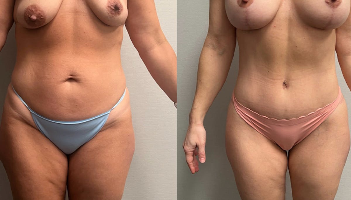 Tummy Tuck Before & After Gallery - Patient 201634 - Image 1