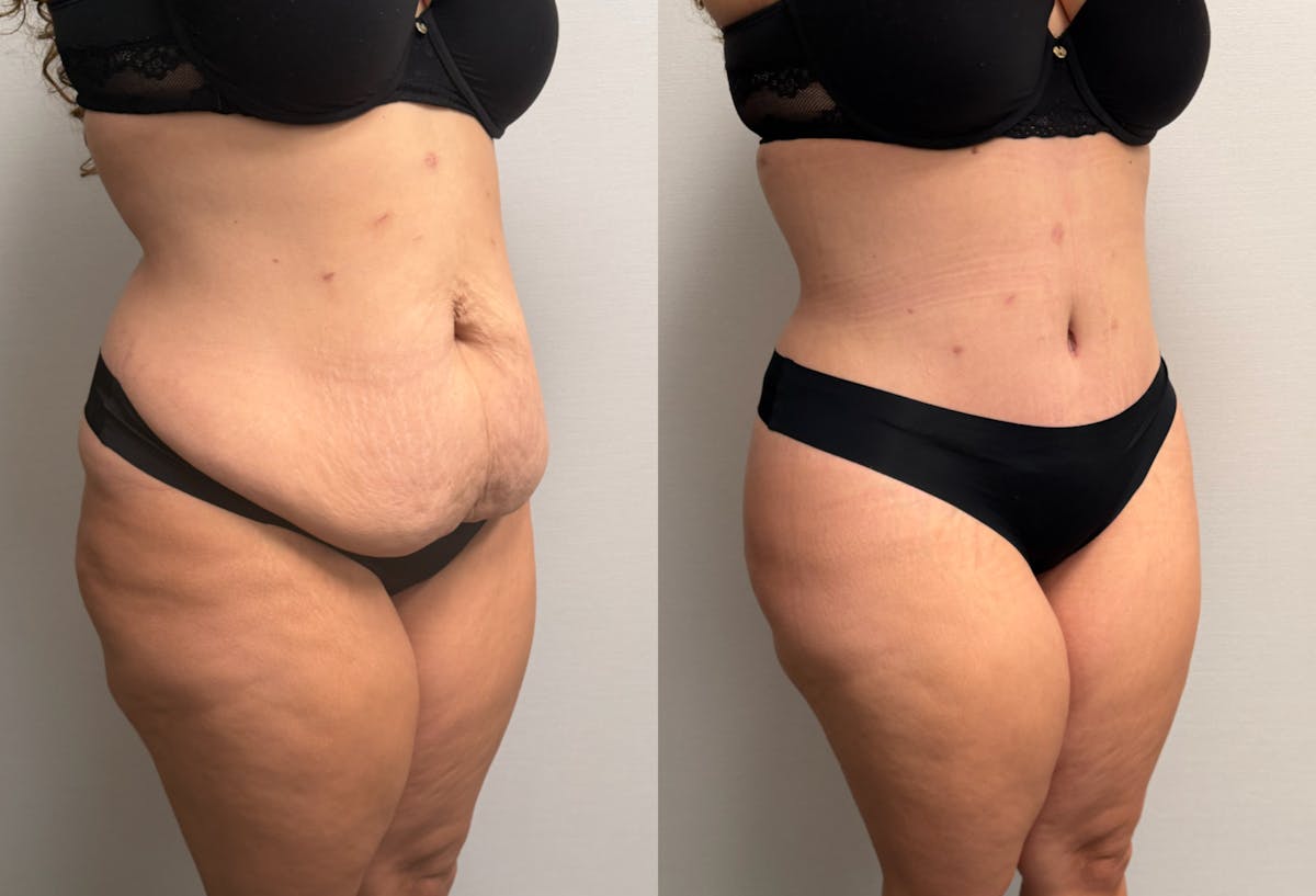 Tummy Tuck Before & After Gallery - Patient 425839 - Image 4