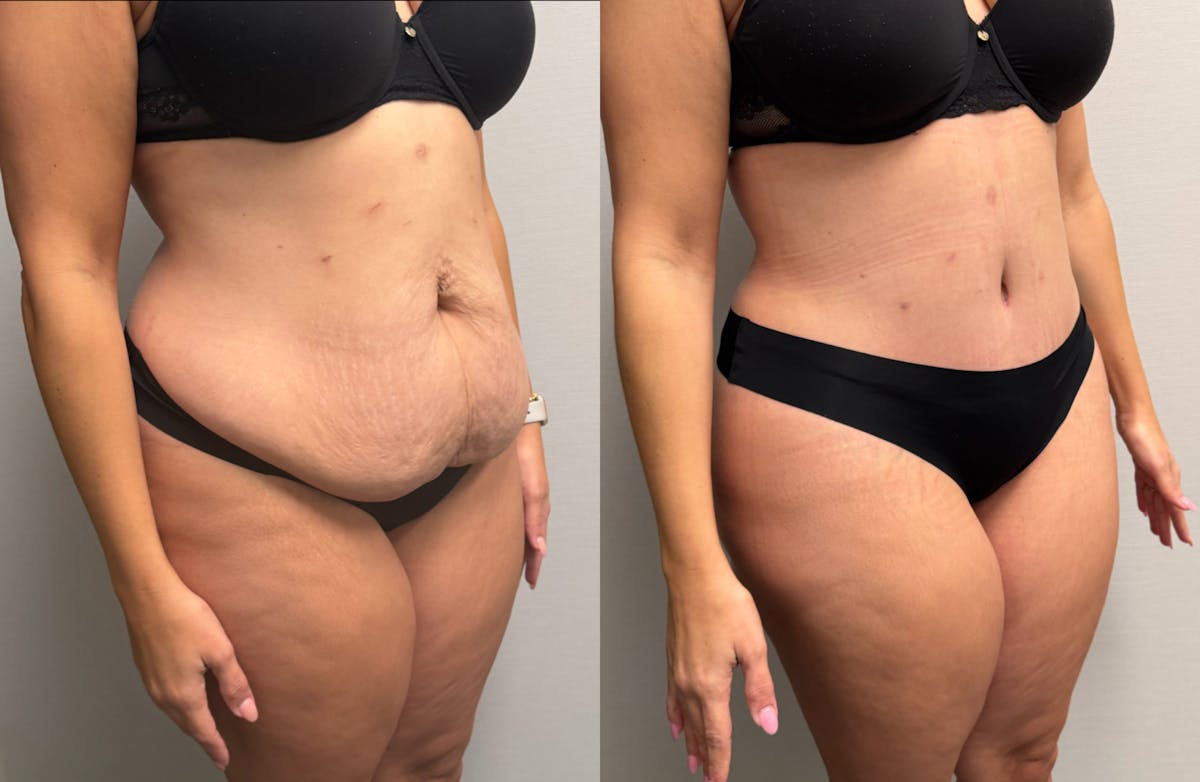 Tummy Tuck Before & After Gallery - Patient 425839 - Image 3