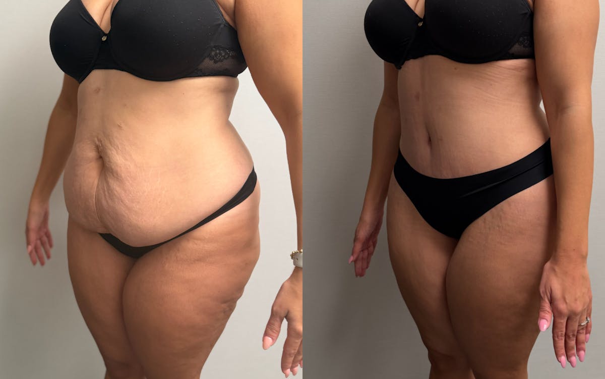 Tummy Tuck Before & After Gallery - Patient 425839 - Image 6