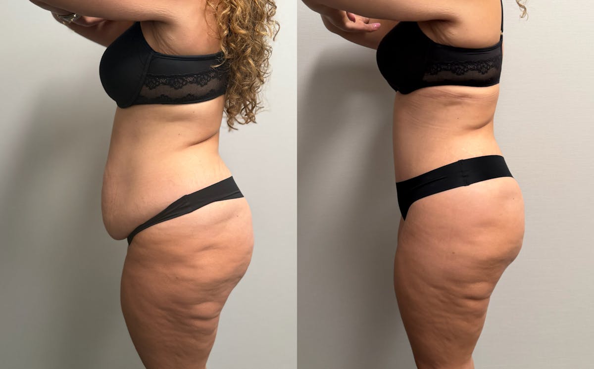 Tummy Tuck Before & After Gallery - Patient 425839 - Image 7