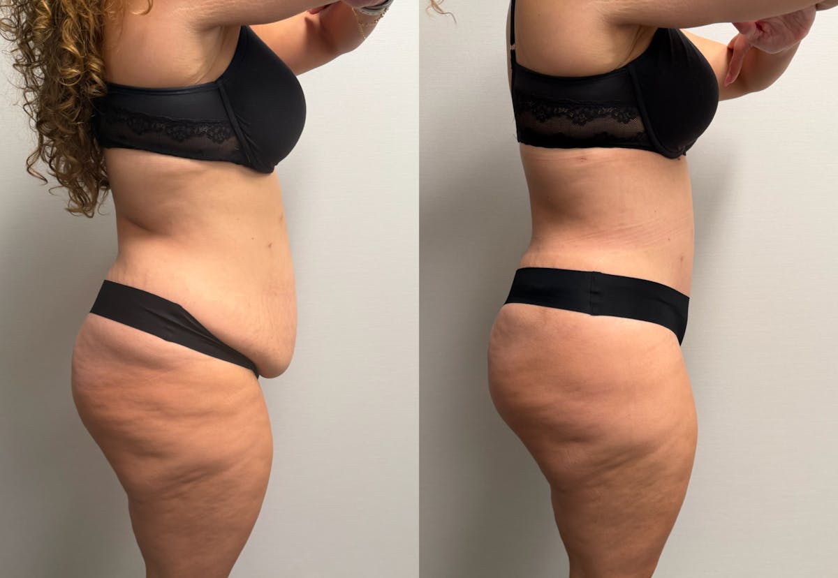Tummy Tuck Before & After Gallery - Patient 425839 - Image 5