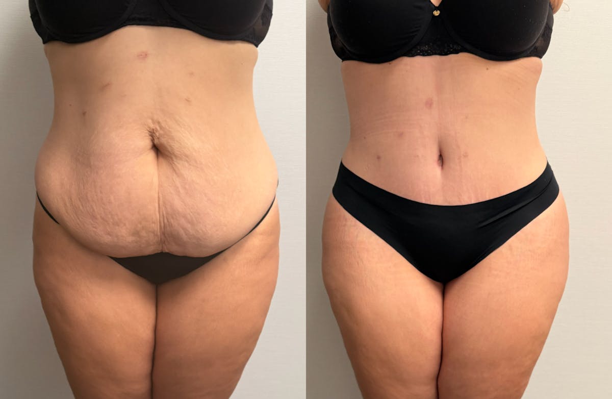Tummy Tuck Before & After Gallery - Patient 425839 - Image 2