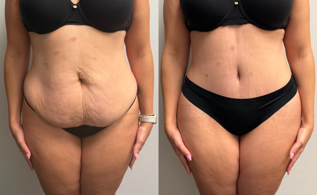 Tummy Tuck Before & After Gallery - Patient 425839 - Image 1