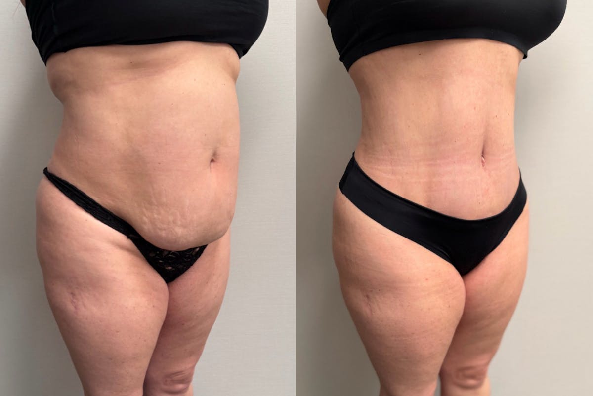 Tummy Tuck Before & After Gallery - Patient 228634 - Image 4