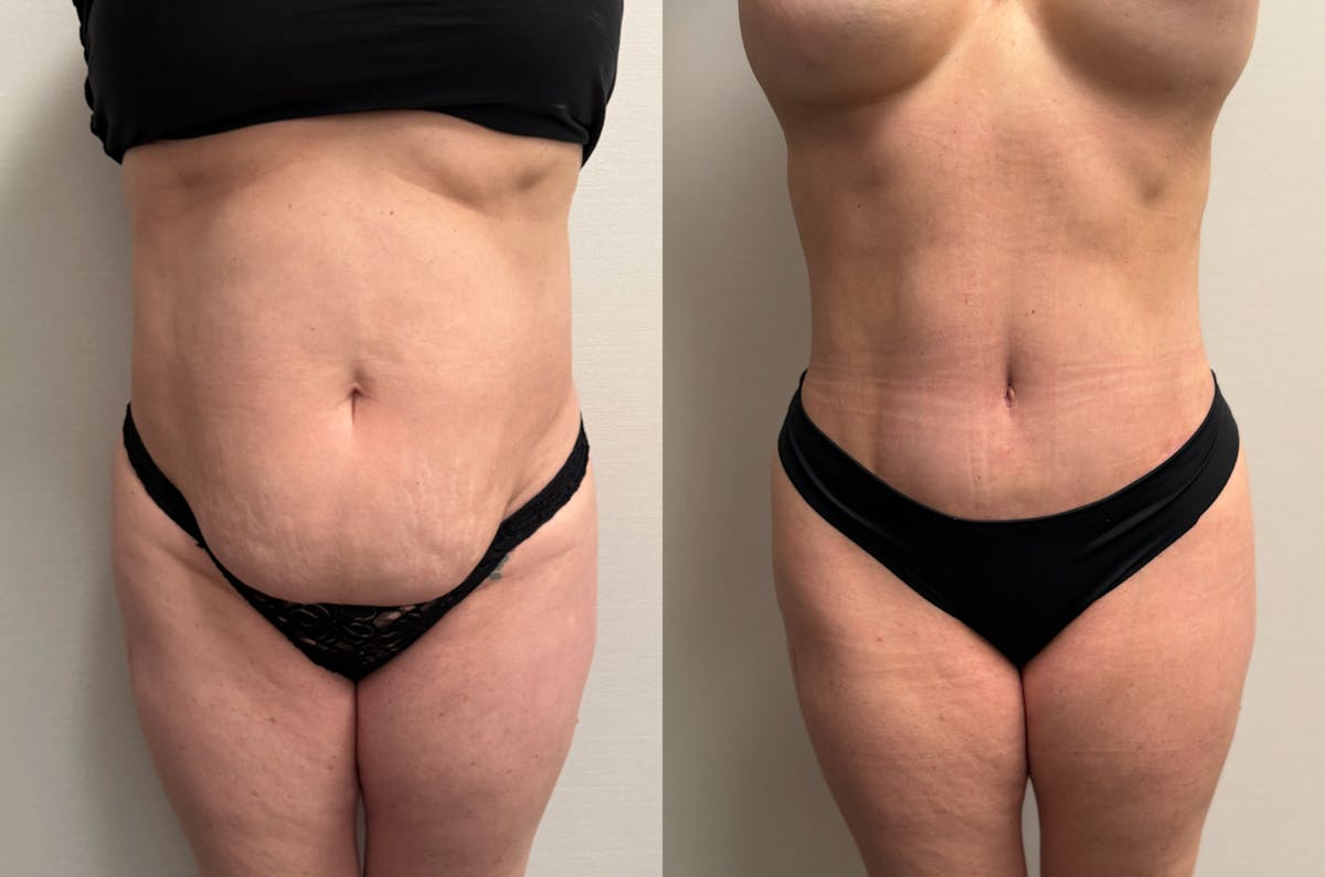 Tummy Tuck Before & After Gallery - Patient 228634 - Image 1