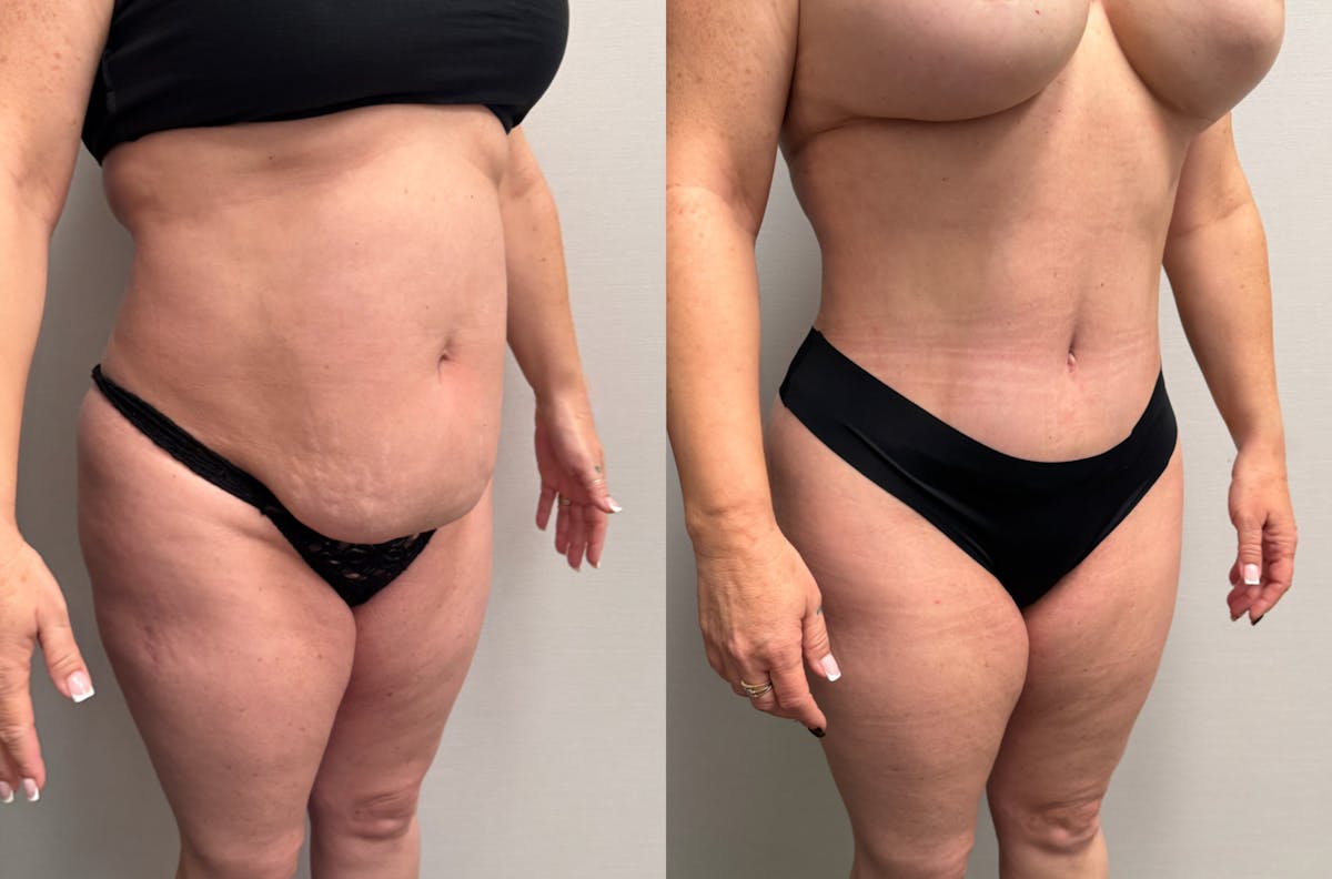 Tummy Tuck Before & After Gallery - Patient 228634 - Image 3