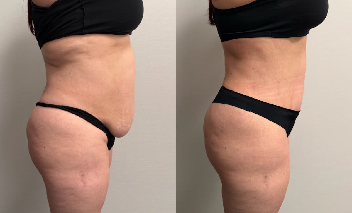 Tummy Tuck Before & After Gallery - Patient 228634 - Image 5