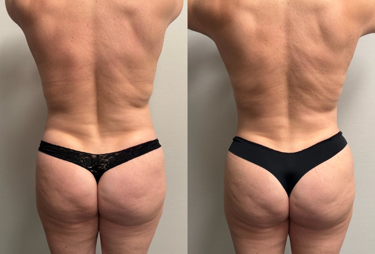 Tummy Tuck Before & After Gallery - Patient 228634 - Image 2