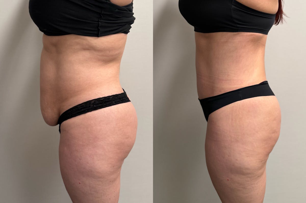 Tummy Tuck Before & After Gallery - Patient 228634 - Image 7