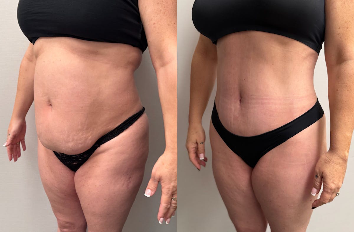 Tummy Tuck Before & After Gallery - Patient 228634 - Image 6