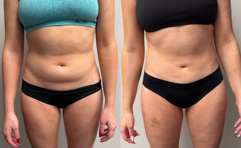 Hybrid Abdominoplasty Before & After Gallery - Patient 236572 - Image 1