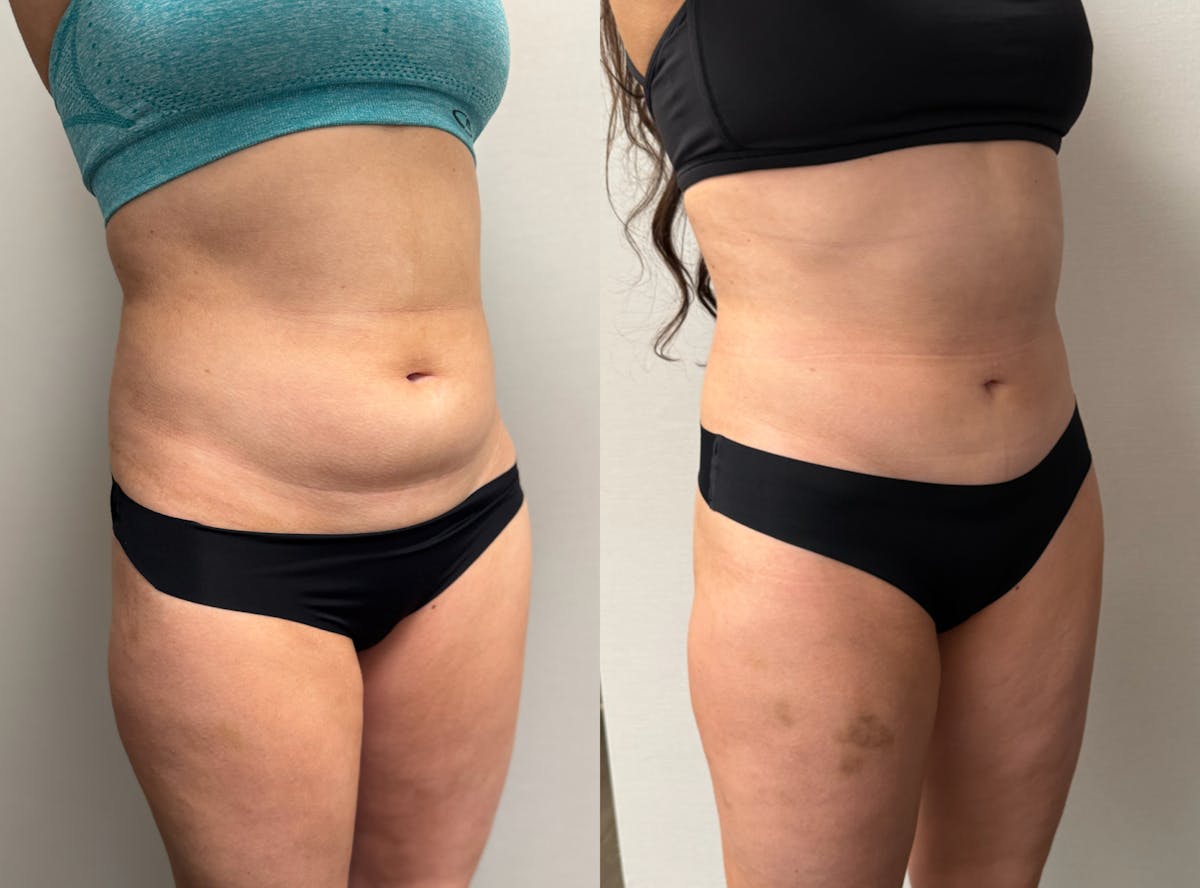 Hybrid Abdominoplasty Before & After Gallery - Patient 236572 - Image 3
