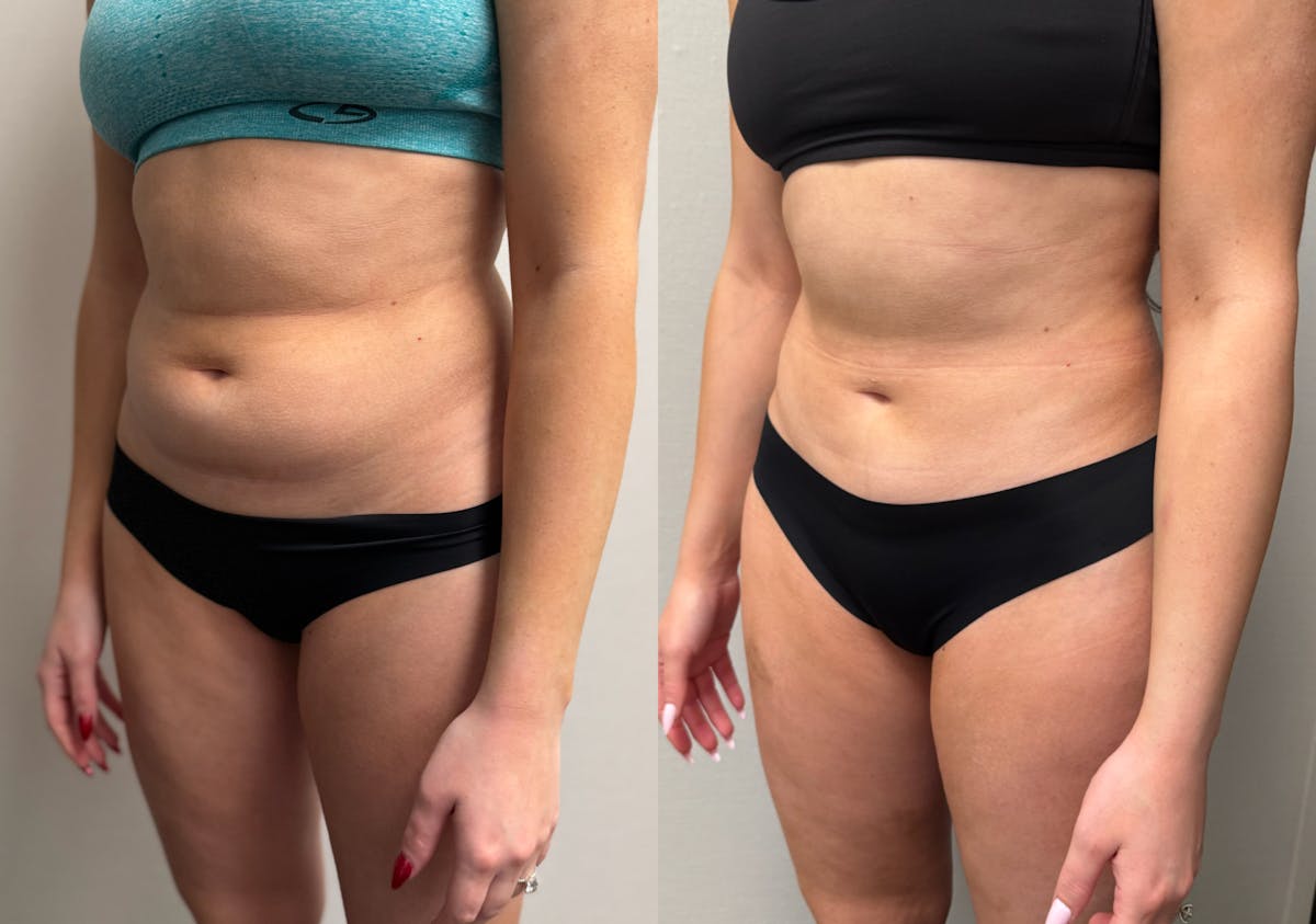 Hybrid Abdominoplasty Before & After Gallery - Patient 236572 - Image 6