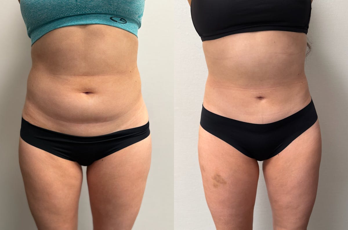 Hybrid Abdominoplasty Before & After Gallery - Patient 236572 - Image 2
