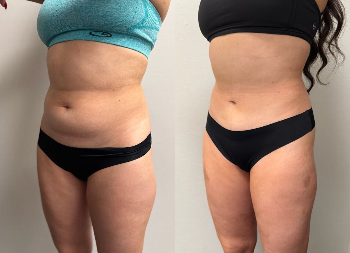 Hybrid Abdominoplasty Before & After Gallery - Patient 236572 - Image 5