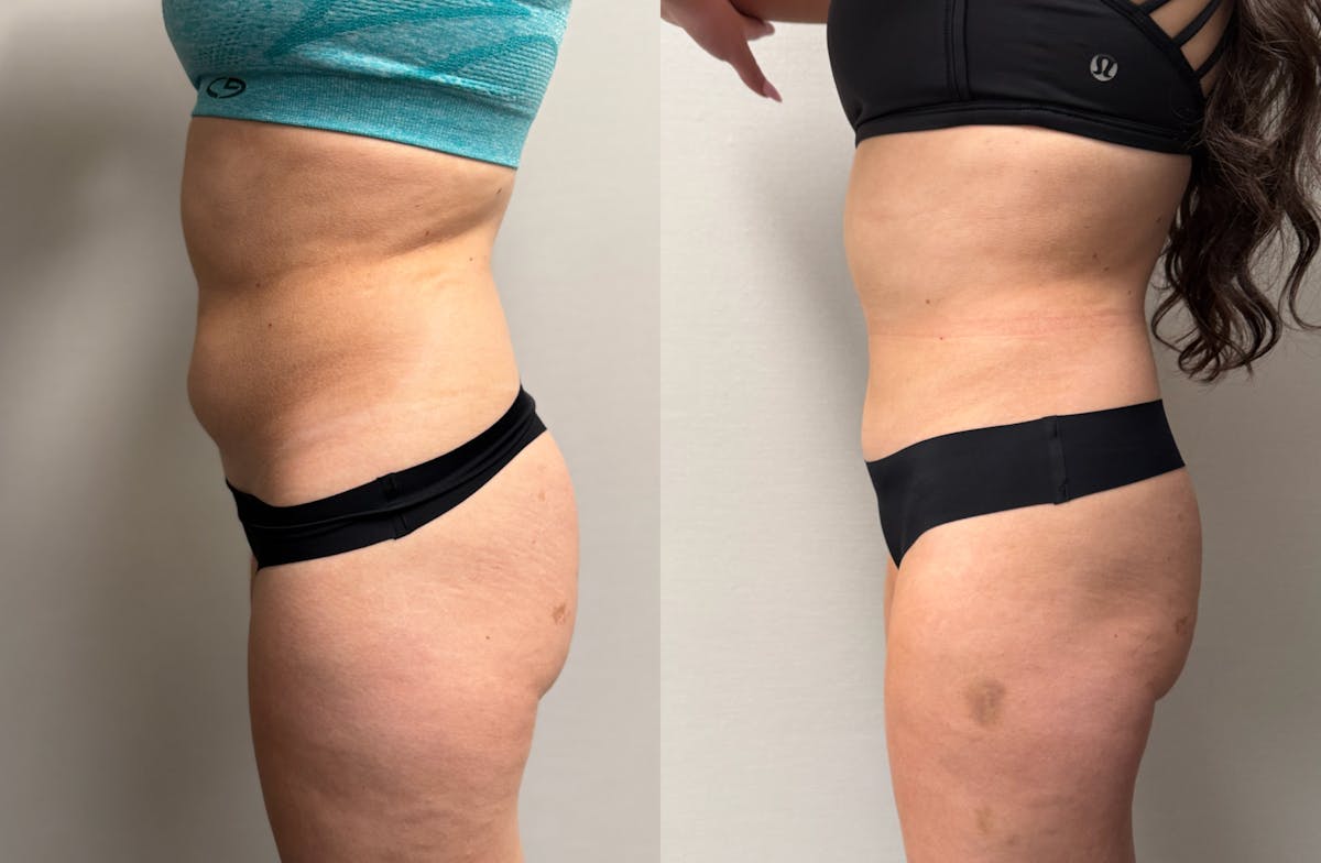 Hybrid Abdominoplasty Before & After Gallery - Patient 236572 - Image 7