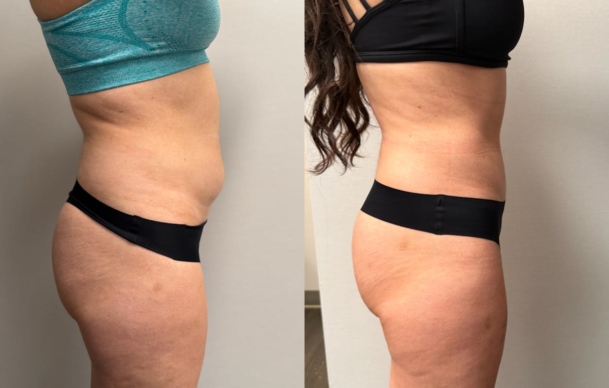 Hybrid Abdominoplasty Before & After Gallery - Patient 236572 - Image 4