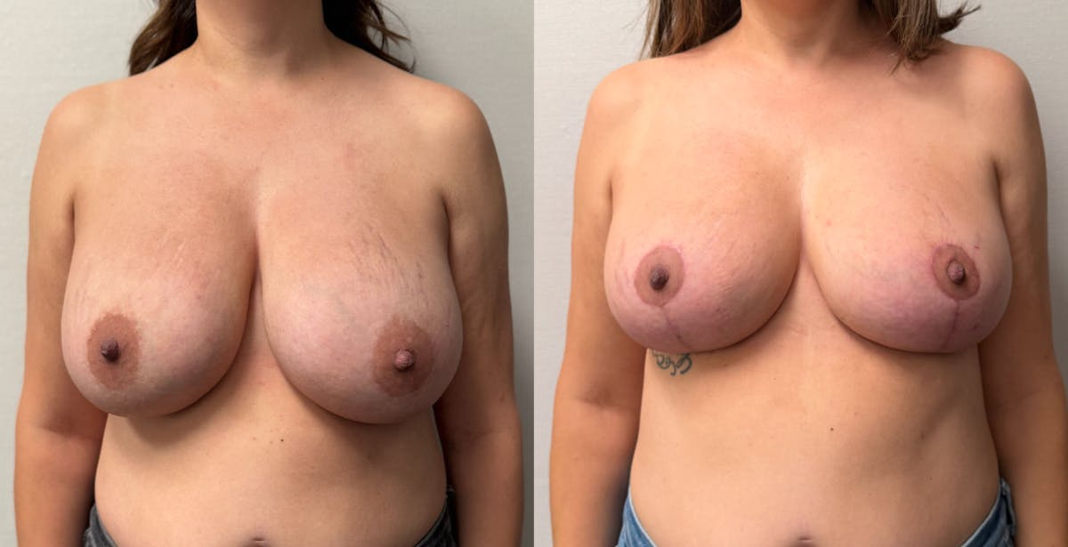 Breast Reduction Before & After Gallery - Patient 390962 - Image 1