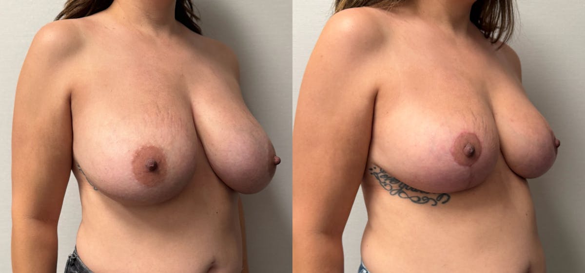 Breast Reduction Before & After Gallery - Patient 390962 - Image 2
