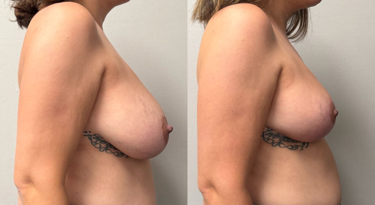 Breast Reduction Before & After Gallery - Patient 390962 - Image 3