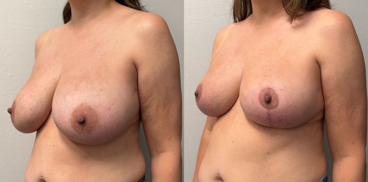 Breast Reduction Before & After Gallery - Patient 390962 - Image 4