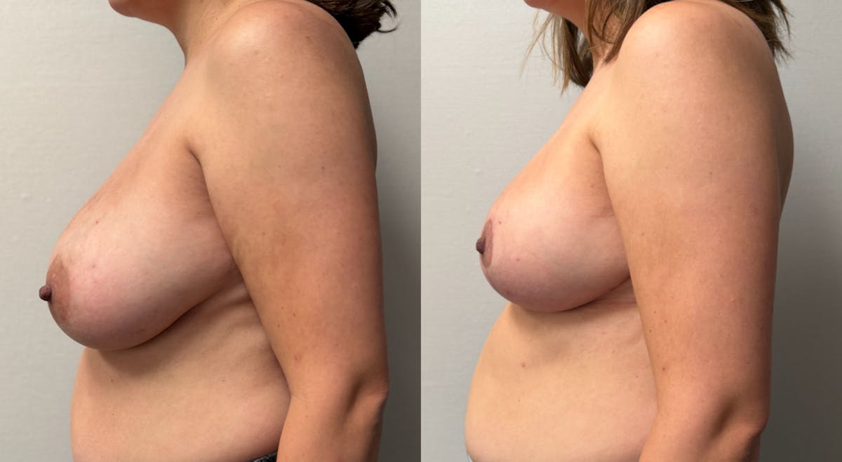 Breast Reduction Before & After Gallery - Patient 390962 - Image 5