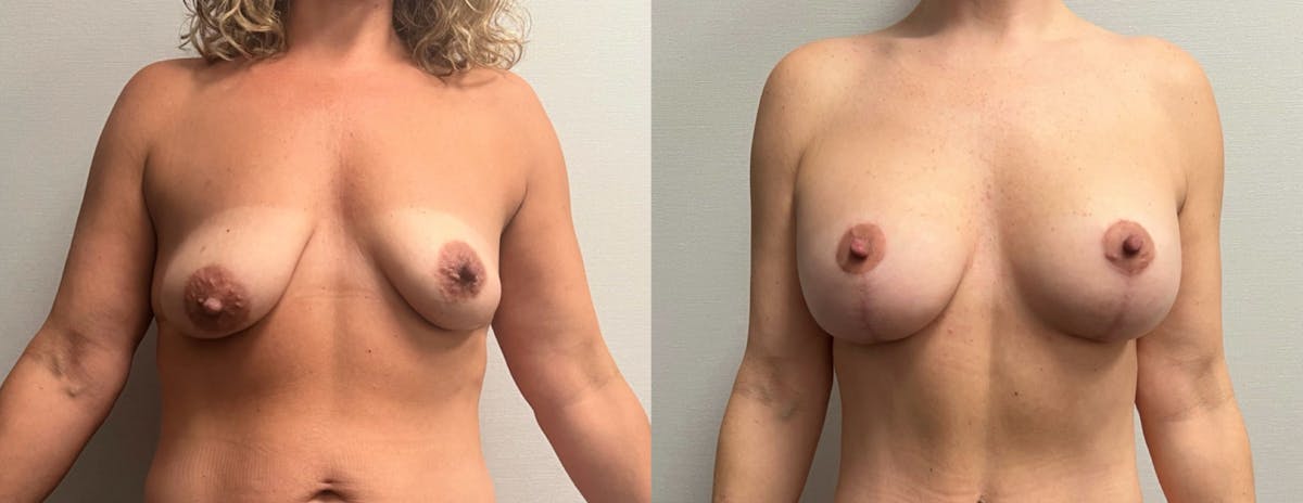 Breast Augmentation with Lift Before & After Gallery - Patient 194568 - Image 1
