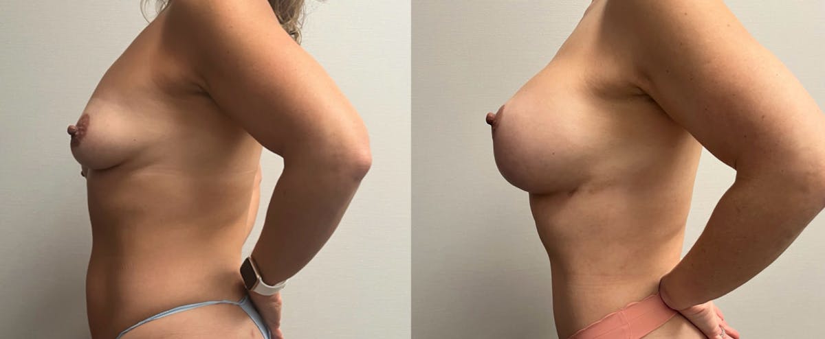 Breast Augmentation with Lift Before & After Gallery - Patient 194568 - Image 5