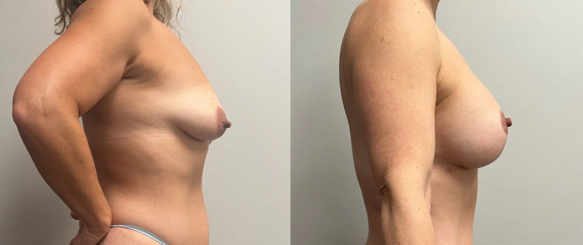 Breast Augmentation with Lift Before & After Gallery - Patient 194568 - Image 3