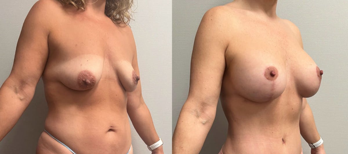 Breast Augmentation with Lift Before & After Gallery - Patient 194568 - Image 2