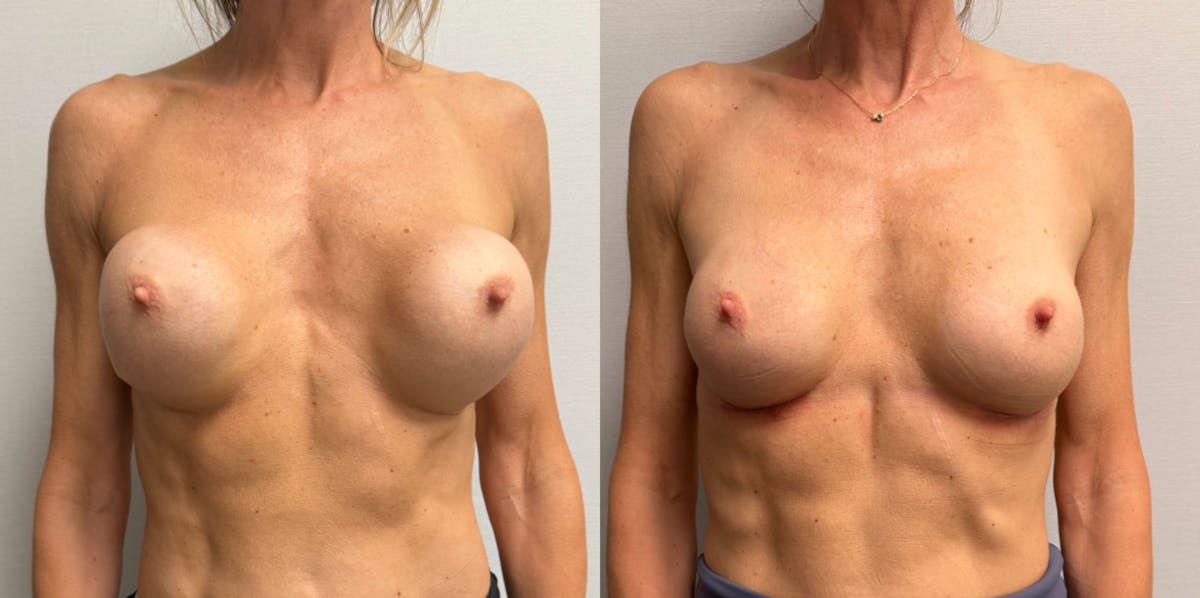 Breast Implant Exchange Before & After Gallery - Patient 229640 - Image 1