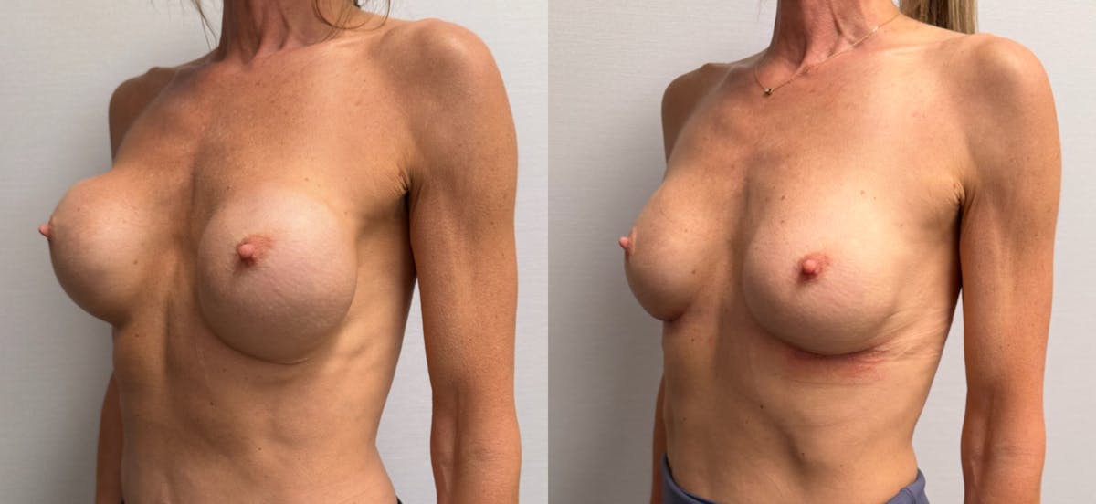 Breast Implant Exchange Before & After Gallery - Patient 229640 - Image 5